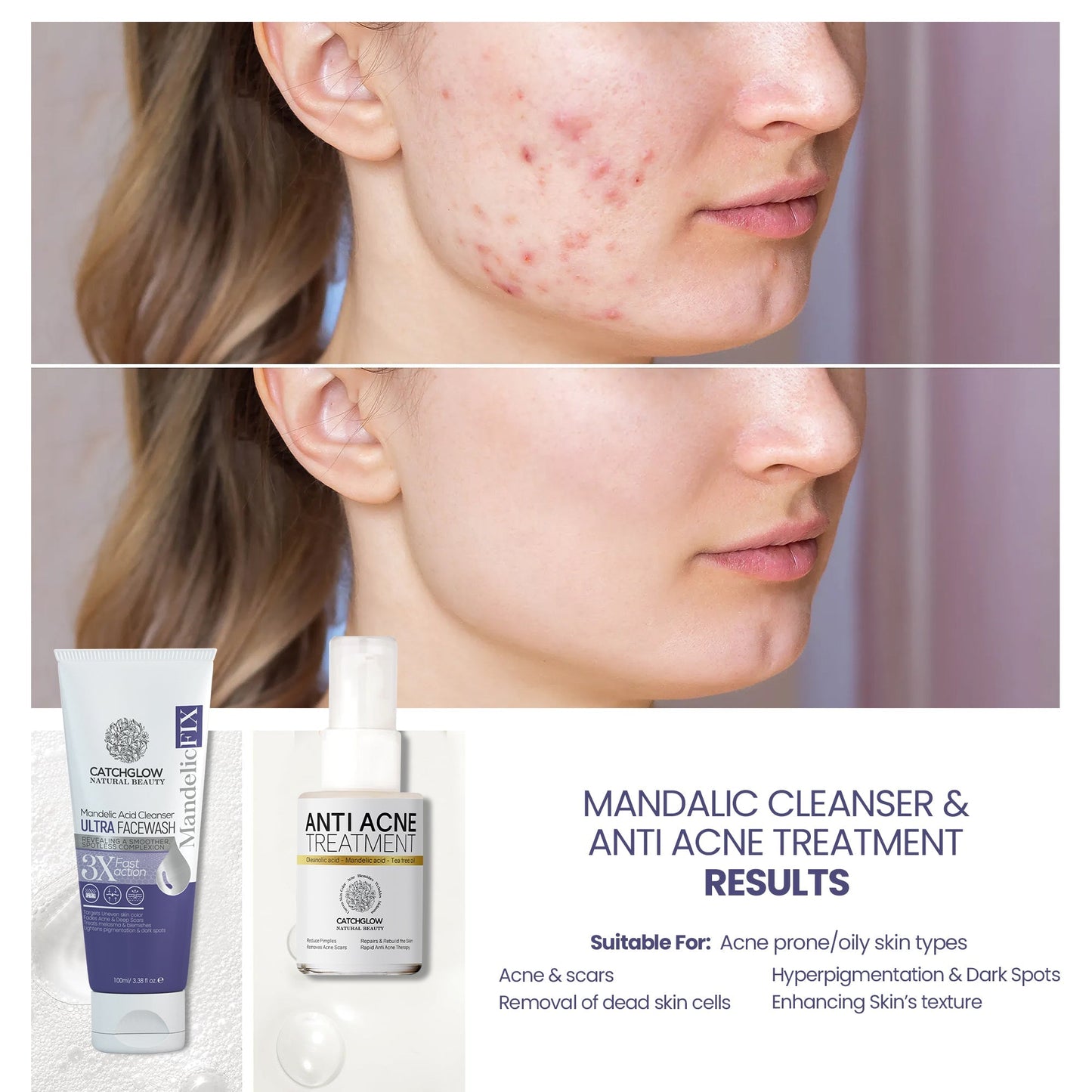 Mandelic Cleanser & Anti Acne Treatment